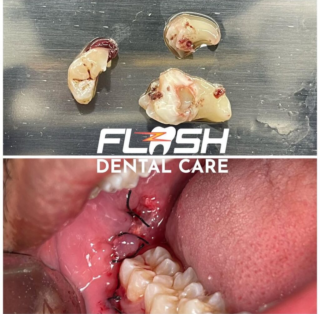 Wisdom teeth